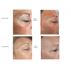 BOTOLIFT DODATEK - zmanjšuje gube, izboljšuje črvstost kože - dodatek pri Microneedlingu