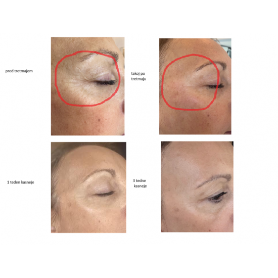 BOTOLIFT - ZMANJŠUJE GUBE, IZBOLJŠUJE ČVRSTOST KOŽE